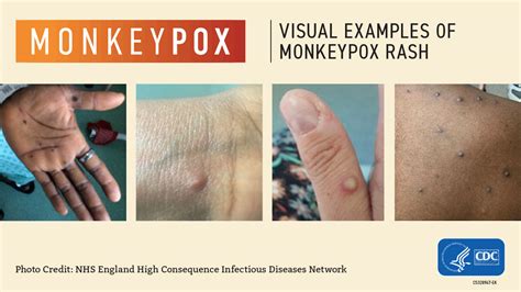 monkey p o r n|About Mpox .